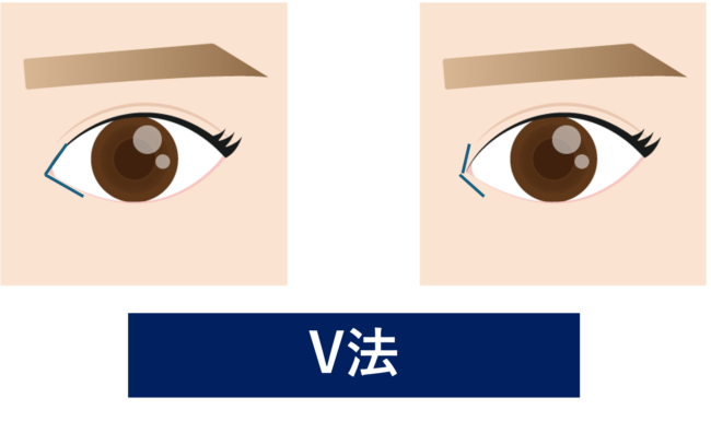 目頭切開法 V法