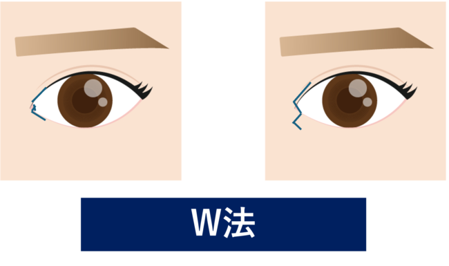 目頭切開法　W法