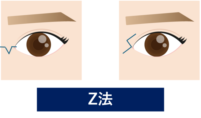 目頭切開法　Z法