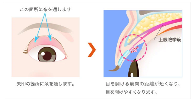 TCB東京中央美容外科 挙筋前転法（クイックデカ目術）