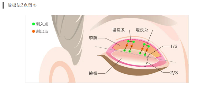 TCB東京中央美容外科 瞼板法