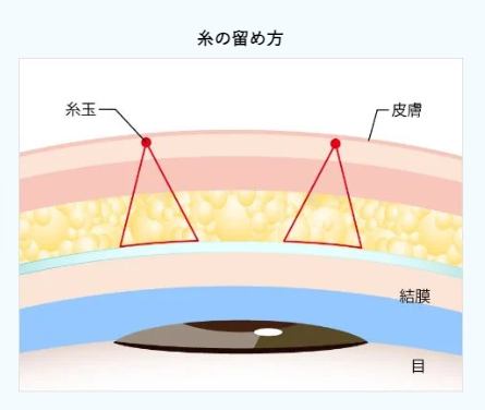 TCB二重術